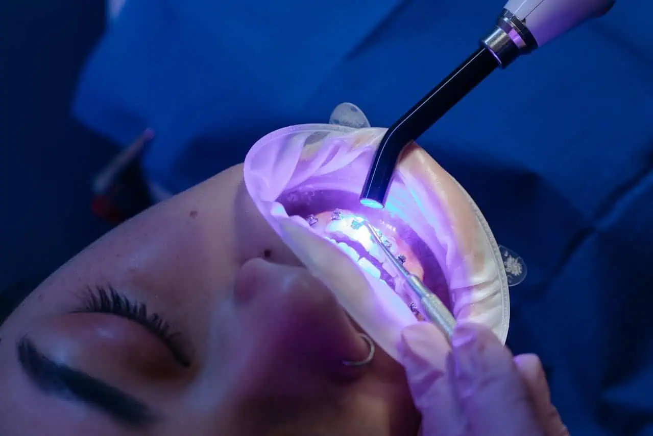 Dental laser procedure for teeth whitening or cavity treatment in a clinical setting, close-up view.